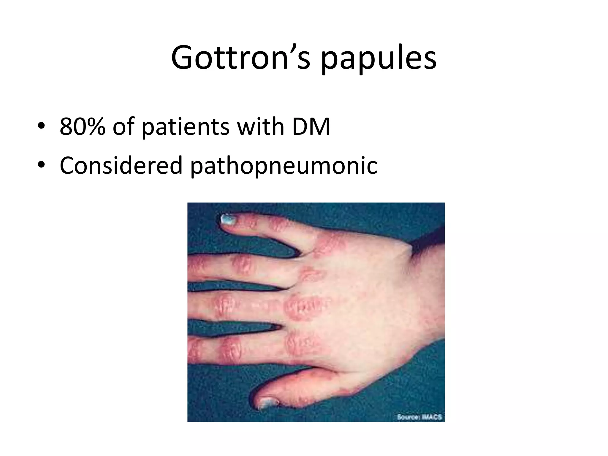 Gottron’s papules
• 80% of patients with DM
• Considered pathopneumonic
 