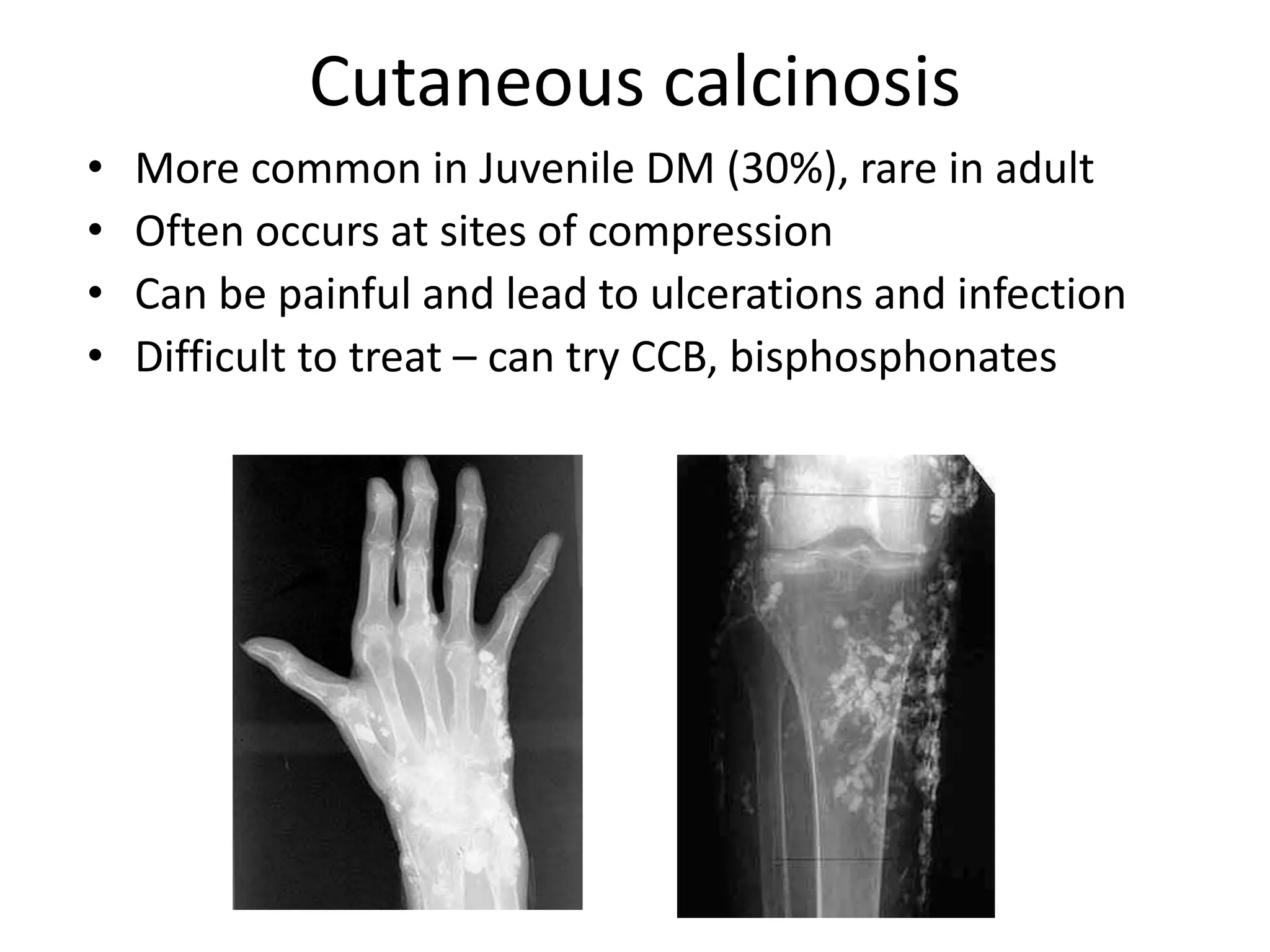 Cutaneous calcinosis
• More common in Juvenile DM (30%), rare in adult
• Often occurs at sites of compression
• Can be painful and lead to ulcerations and infection
• Difficult to treat – can try CCB, bisphosphonates
 