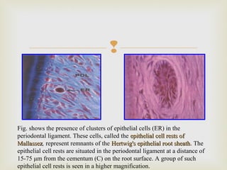 
Fig. shows the presence of clusters of epithelial cells (ER) in the
periodontal ligament. These cells, called the epithelial cell rests ofepithelial cell rests of
MallassezMallassez, represent remnants of the Hertwig's epithelial root sheathHertwig's epithelial root sheath. The
epithelial cell rests are situated in the periodontal ligament at a distance of
15-75 μm from the cementum (C) on the root surface. A group of such
epithelial cell rests is seen in a higher magnification.
 