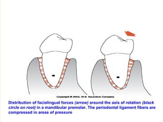 Distribution of faciolingual forces (arrow) around the axis of rotation (black
circle on root) in a mandibular premolar. The periodontal ligament fibers are
compressed in areas of pressure
 