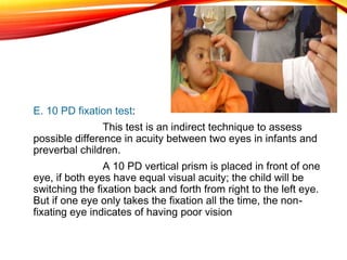 E. 10 PD fixation test:
This test is an indirect technique to assess
possible difference in acuity between two eyes in infants and
preverbal children.
A 10 PD vertical prism is placed in front of one
eye, if both eyes have equal visual acuity; the child will be
switching the fixation back and forth from right to the left eye.
But if one eye only takes the fixation all the time, the non-
fixating eye indicates of having poor vision
 