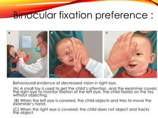 Binocular fixation preference :
Behavioural evidence of decreased vision in right eye.
(A) A small toy is used to get the child’s attention, and the examiner covers
the right eye to monitor fixation of the left eye. The child fixates on the toy
without objecting.
(B) When the left eye is covered, the child objects and tries to move the
examiner’s hand.
(C) When the right eye is covered, the child does not object and tracks
the object.
 