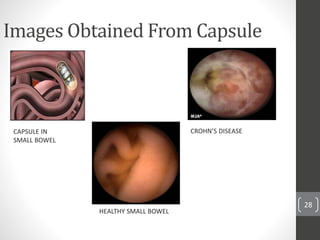 28
Images Obtained From Capsule
CROHN’S DISEASE
HEALTHY SMALL BOWEL
CAPSULE IN
SMALL BOWEL
 