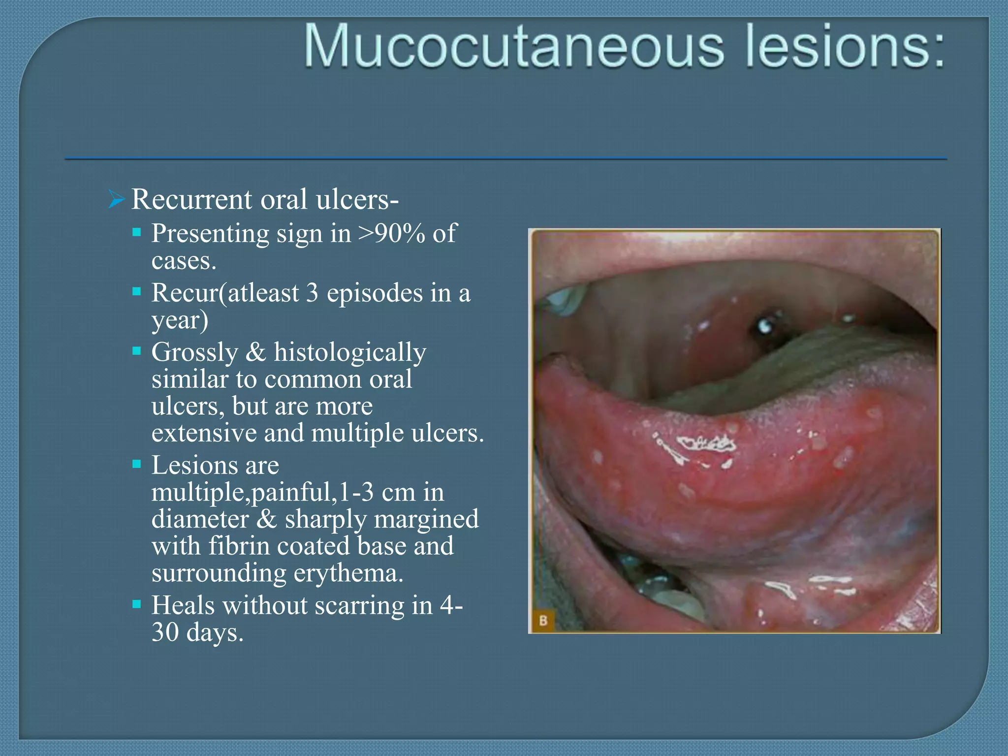 behcets disease | PPTX