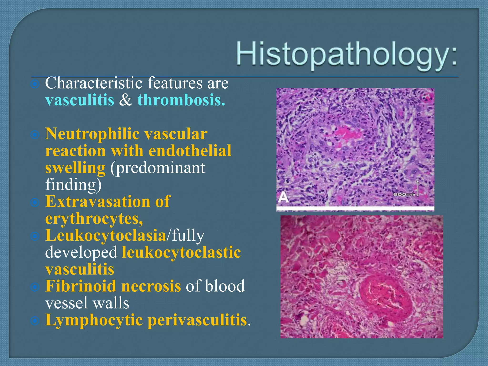 behcets disease | PPTX