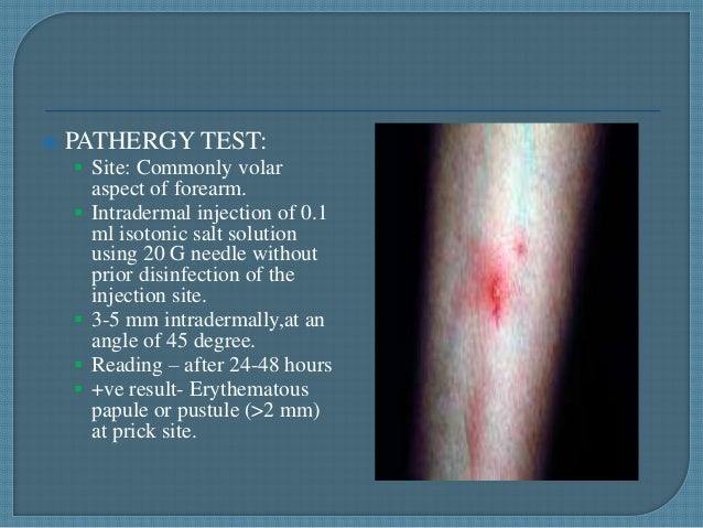 Shingles (Herpes Zoster) - MedicineNet Shingles (Herpes Zoster) - MedicineNet