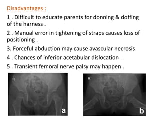 Disadvantages :
1 . Difficult to educate parents for donning & doffing
of the harness .
2 . Manual error in tightening of straps causes loss of
positioning .
3. Forceful abduction may cause avascular necrosis
4 . Chances of inferior acetabular dislocation .
5 . Transient femoral nerve palsy may happen .
 