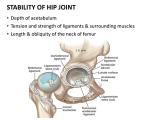 • Depth of acetabulum
• Tension and strength of ligaments & surrounding muscles
• Length & obliquity of the neck of femur
STABILITY OF HIP JOINT
 