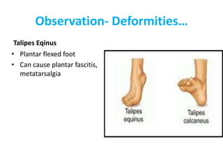 Observation- Deformities…
Talipes Eqinus
• Plantar flexed foot
• Can cause plantar fascitis,
metatarsalgia
 
