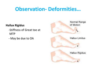 Observation- Deformities…
Hallux Rigidus
-Stiffness of Great toe at
MTP
- May be due to OA
 