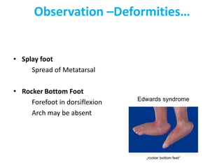 Observation –Deformities…
• Splay foot
Spread of Metatarsal
• Rocker Bottom Foot
Forefoot in dorsiflexion
Arch may be absent
 