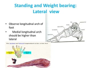Standing and Weight bearing:
Lateral view
• Observe longitudnal arch of
foot
• Medial longitudnal arch
should be higher than
lateral
 