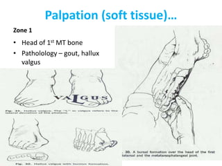 Palpation (soft tissue)…
Zone 1
• Head of 1st MT bone
• Patholology – gout, hallux
valgus
 