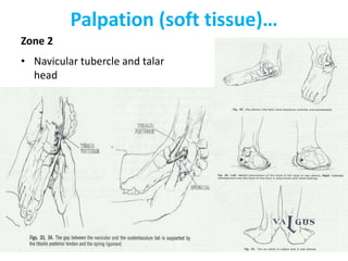 Palpation (soft tissue)…
Zone 2
• Navicular tubercle and talar
head
 