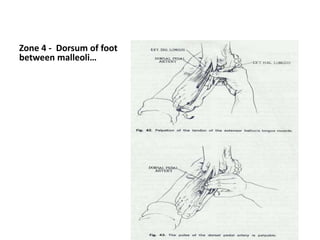 Zone 4 - Dorsum of foot
between malleoli…
 