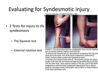 Evaluating for Syndesmotic injury
• 2 Tests for injury to the
syndesmosis
– The Squeeze test
– External rotation test
 