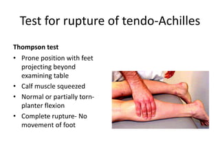 Test for rupture of tendo-Achilles
Thompson test
• Prone position with feet
projecting beyond
examining table
• Calf muscle squeezed
• Normal or partially torn-
planter flexion
• Complete rupture- No
movement of foot
 