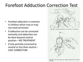 Forefoot Adduction Correction Test
• Forefoot adduction is common
in children which may or may
not need correction
• If adduction can be corrected
manually and abduction can
be done beyond neutral
position – NO TREATMENT
• If only partially corrected to
neutral or less than neutral –
CAST CORRECTION
 