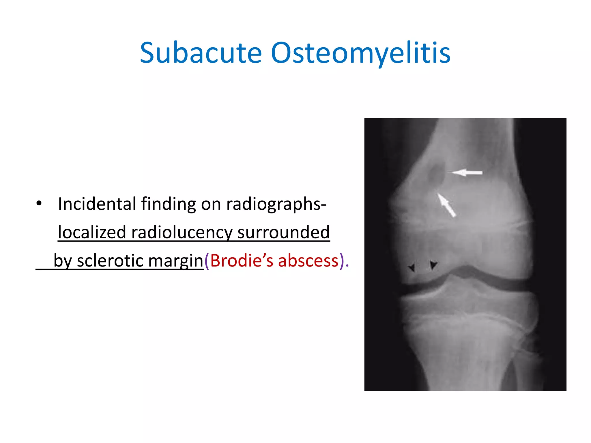 Subacute Osteomyelitis
• Incidental finding on radiographs-
localized radiolucency surrounded
by sclerotic margin(Brodie’s abscess).
 