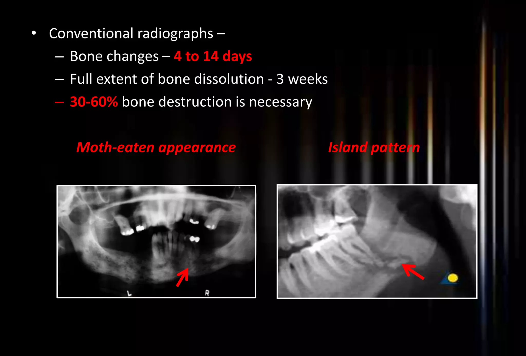 Osteomyelitis and osteoradionecrosis of jaws | PPTX