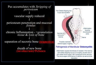 Pus accumulates with Stripping of
periosteum
⇃
vascular supply reduced
⇃
periosteum penetration and mucosal
fistulas
⇃
chronic Inflammation - >granulation
tissue & lysis of bone
⇃
separation of necrotic bone (sequestra)
⇃
sheath of new bone
(involucrum)cloaca
 