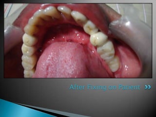 After Fixing on Patient
 