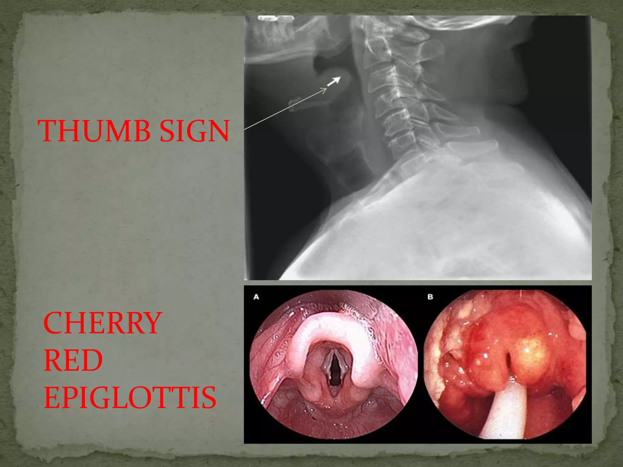 THUMB SIGN
CHERRY
RED
EPIGLOTTIS
 