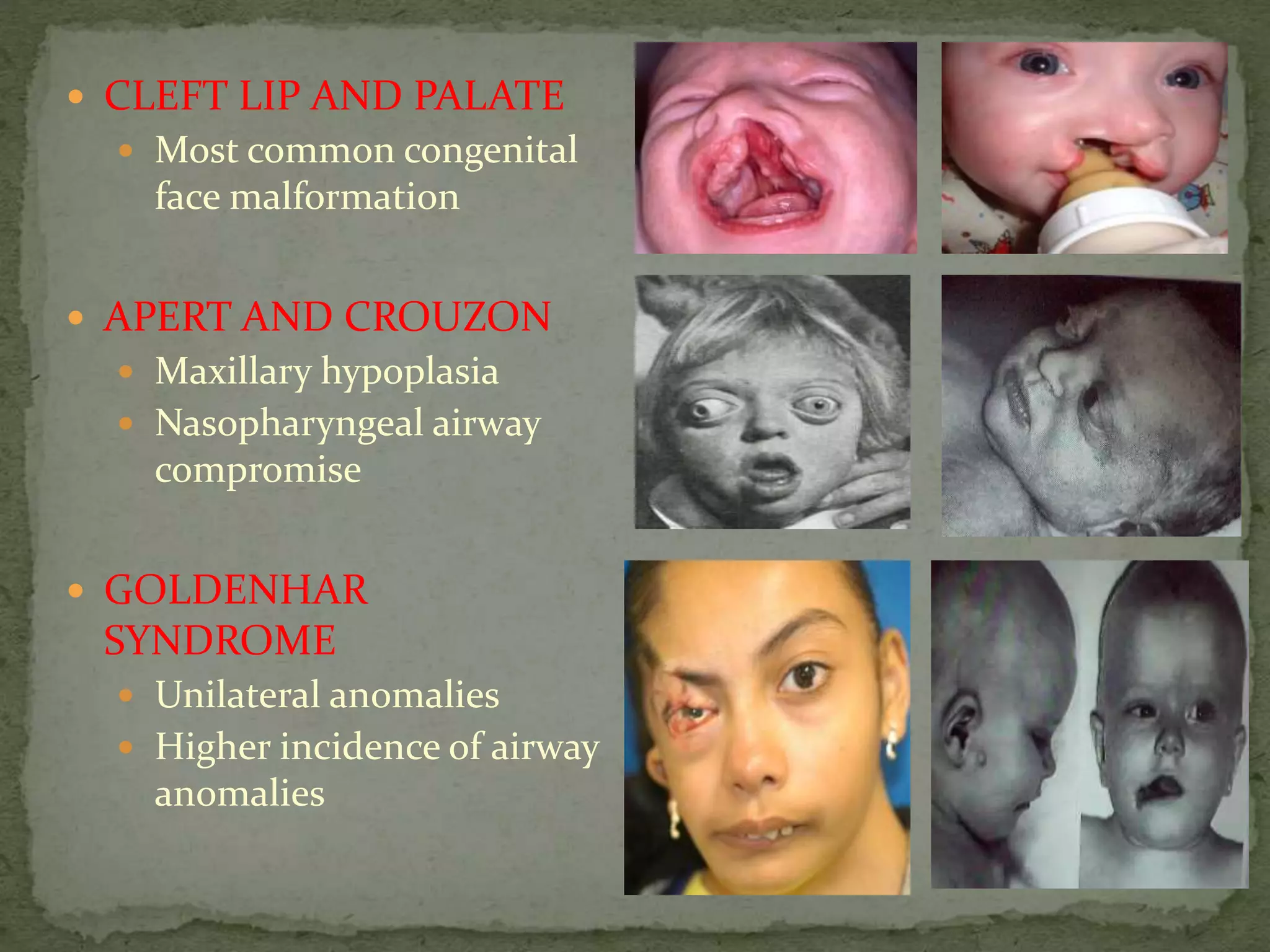  CLEFT LIP AND PALATE
 Most common congenital
face malformation
 APERT AND CROUZON
 Maxillary hypoplasia
 Nasopharyngeal airway
compromise
 GOLDENHAR
SYNDROME
 Unilateral anomalies
 Higher incidence of airway
anomalies
 