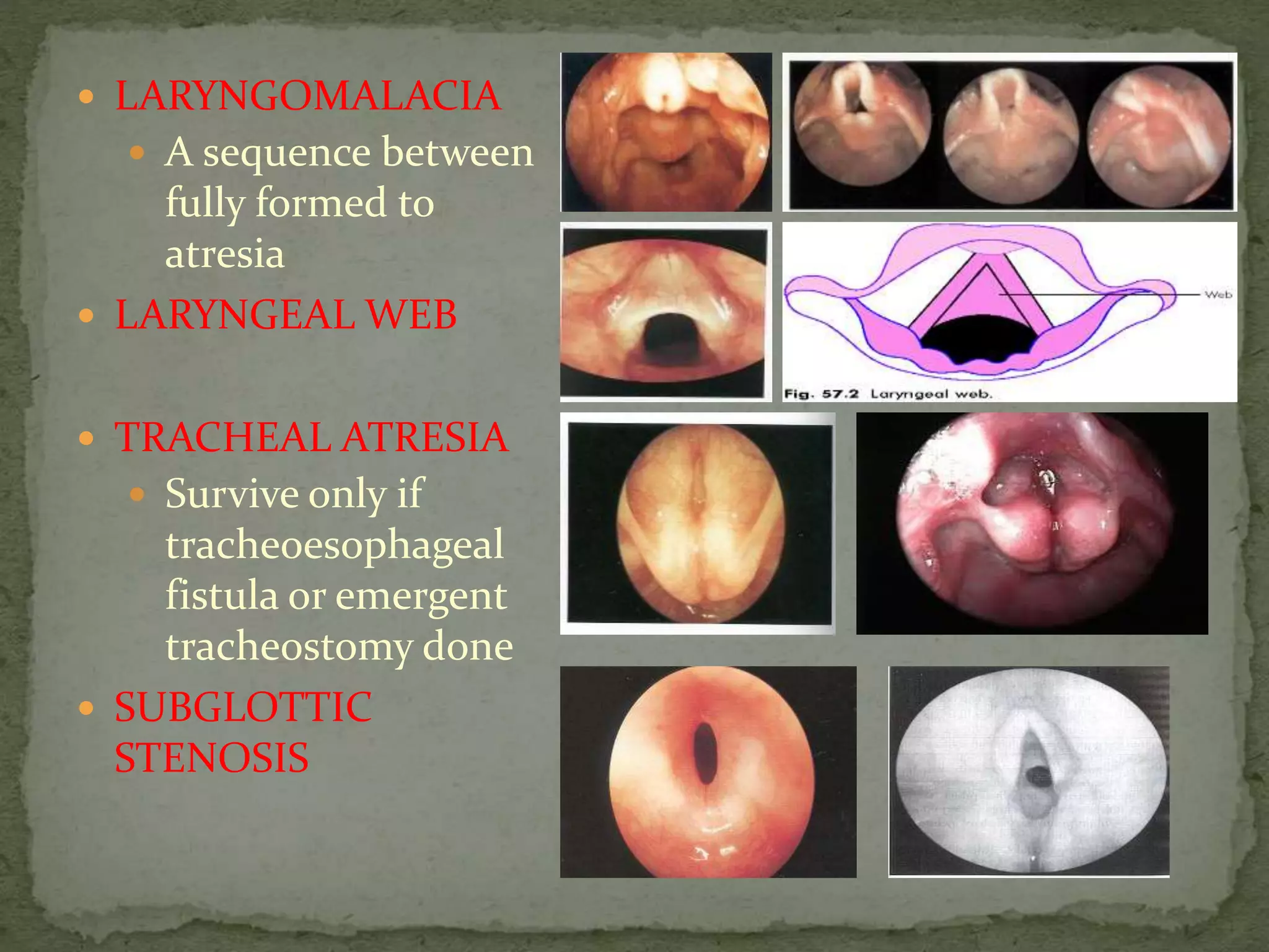  LARYNGOMALACIA
 A sequence between
fully formed to
atresia
 LARYNGEAL WEB
 TRACHEAL ATRESIA
 Survive only if
tracheoesophageal
fistula or emergent
tracheostomy done
 SUBGLOTTIC
STENOSIS
 