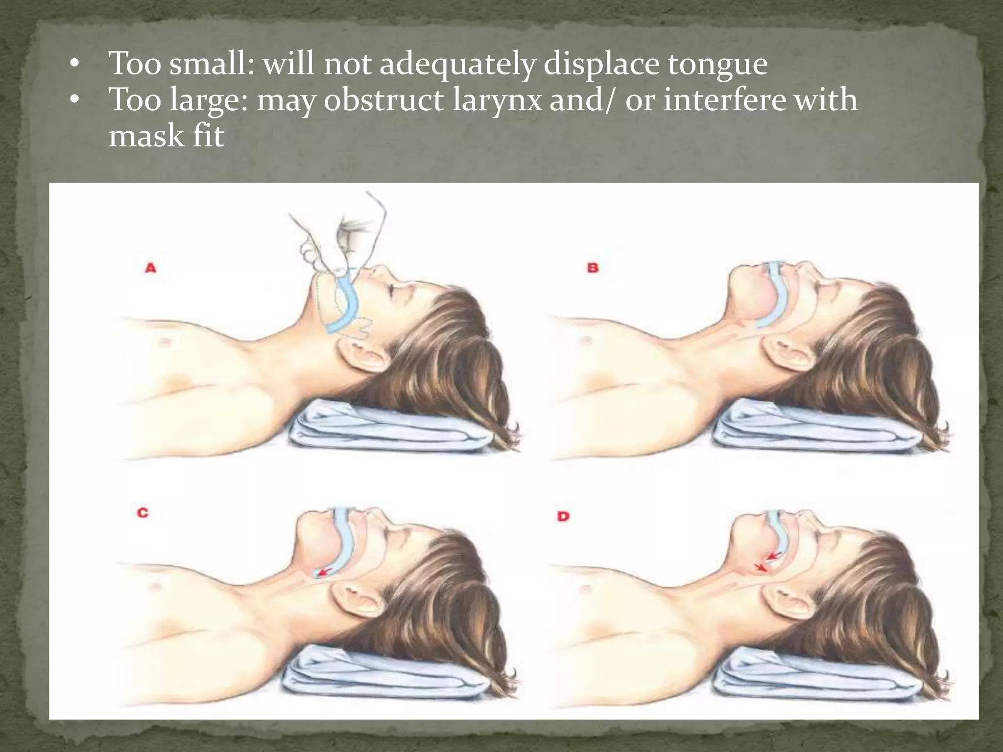 • Too small: will not adequately displace tongue
• Too large: may obstruct larynx and/ or interfere with
mask fit
 