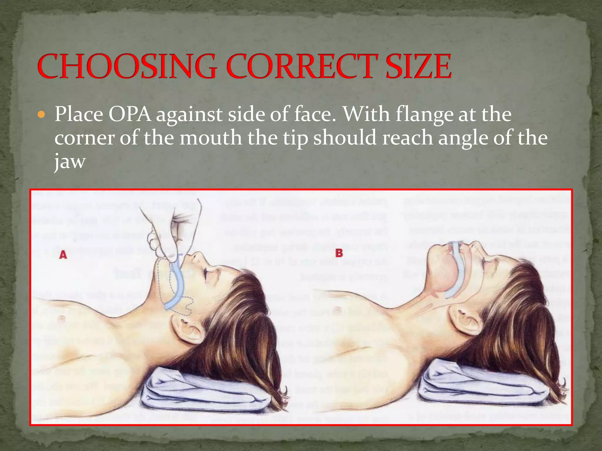  Place OPA against side of face. With flange at the
corner of the mouth the tip should reach angle of the
jaw
 