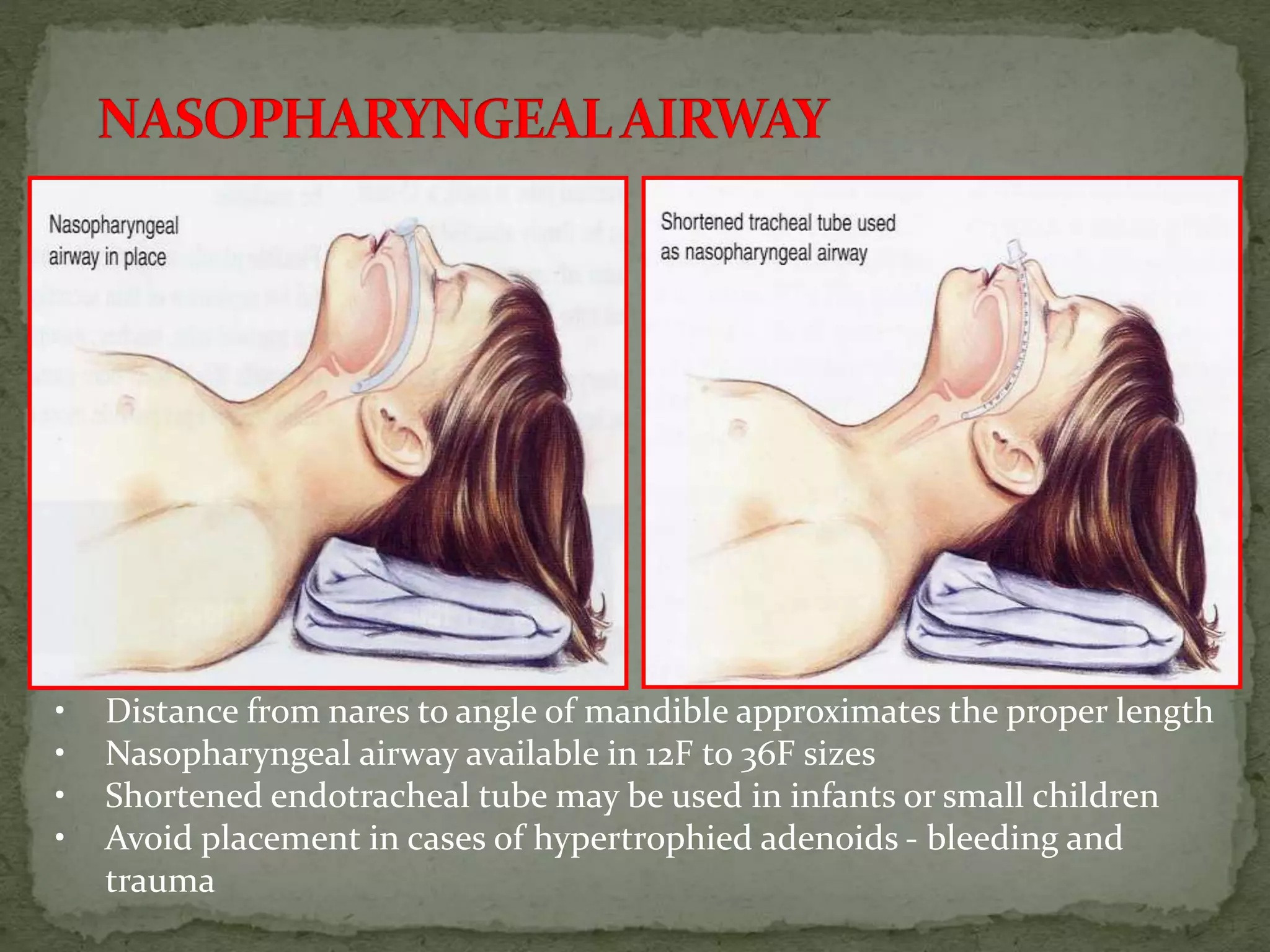 • Distance from nares to angle of mandible approximates the proper length
• Nasopharyngeal airway available in 12F to 36F sizes
• Shortened endotracheal tube may be used in infants or small children
• Avoid placement in cases of hypertrophied adenoids - bleeding and
trauma
 