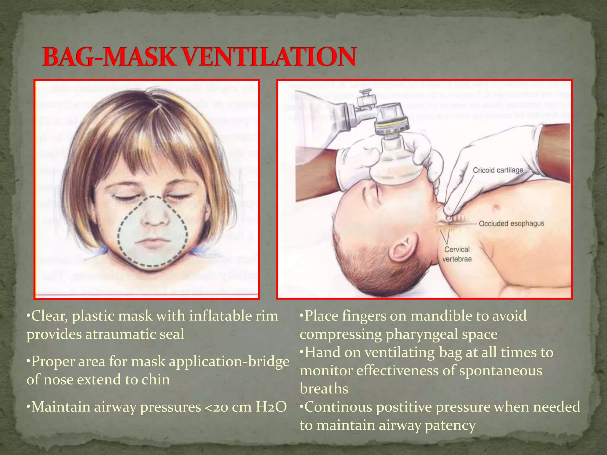 •Clear, plastic mask with inflatable rim
provides atraumatic seal
•Proper area for mask application-bridge
of nose extend to chin
•Maintain airway pressures <20 cm H2O
•Place fingers on mandible to avoid
compressing pharyngeal space
•Hand on ventilating bag at all times to
monitor effectiveness of spontaneous
breaths
•Continous postitive pressure when needed
to maintain airway patency
 