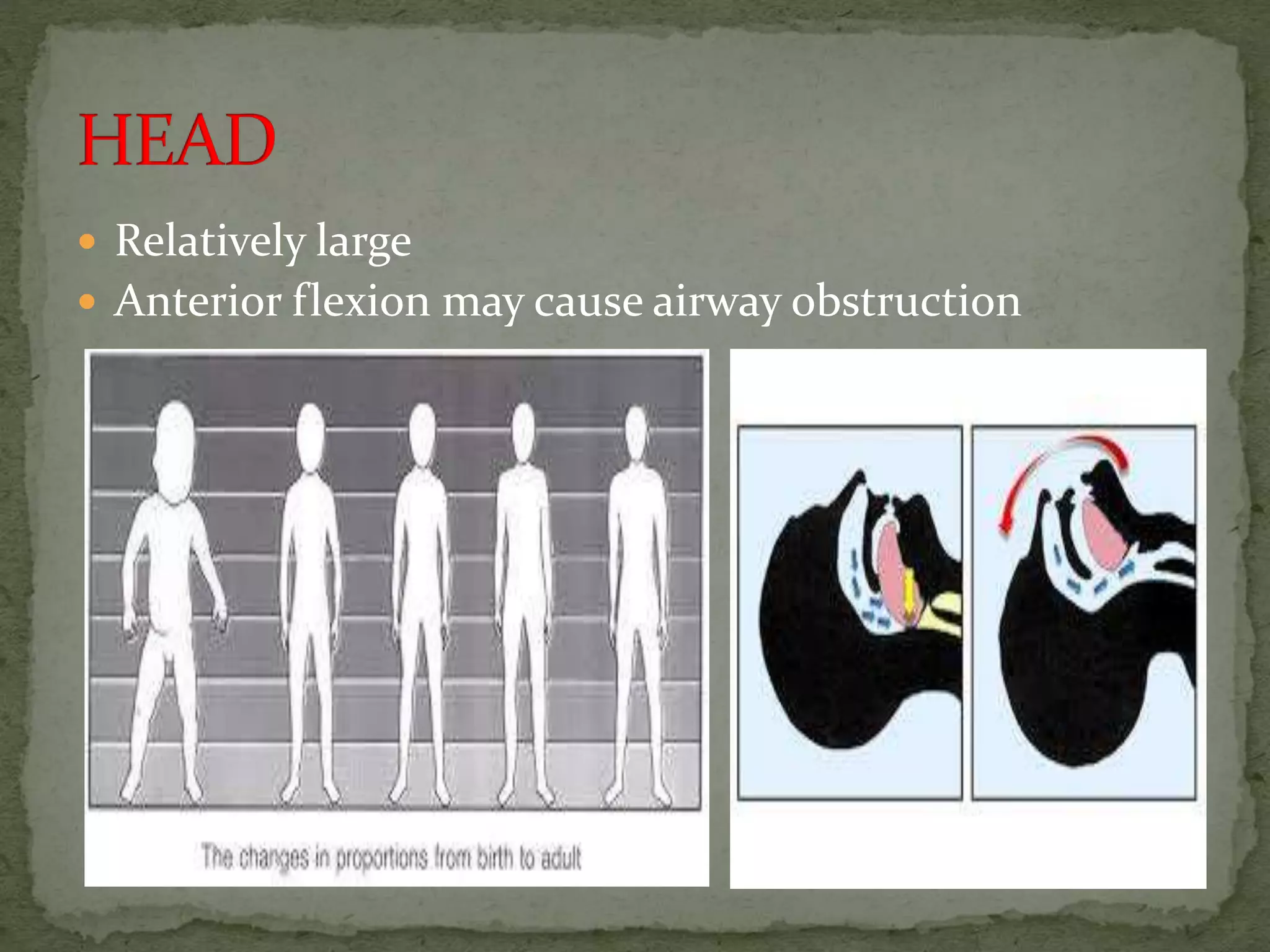  Relatively large
 Anterior flexion may cause airway obstruction
 