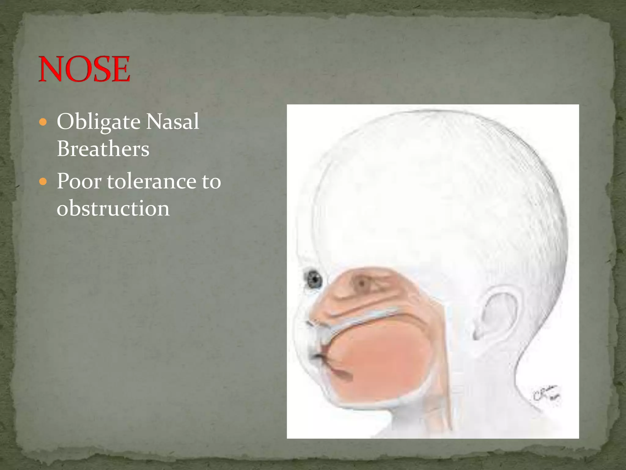  Obligate Nasal
Breathers
 Poor tolerance to
obstruction
 