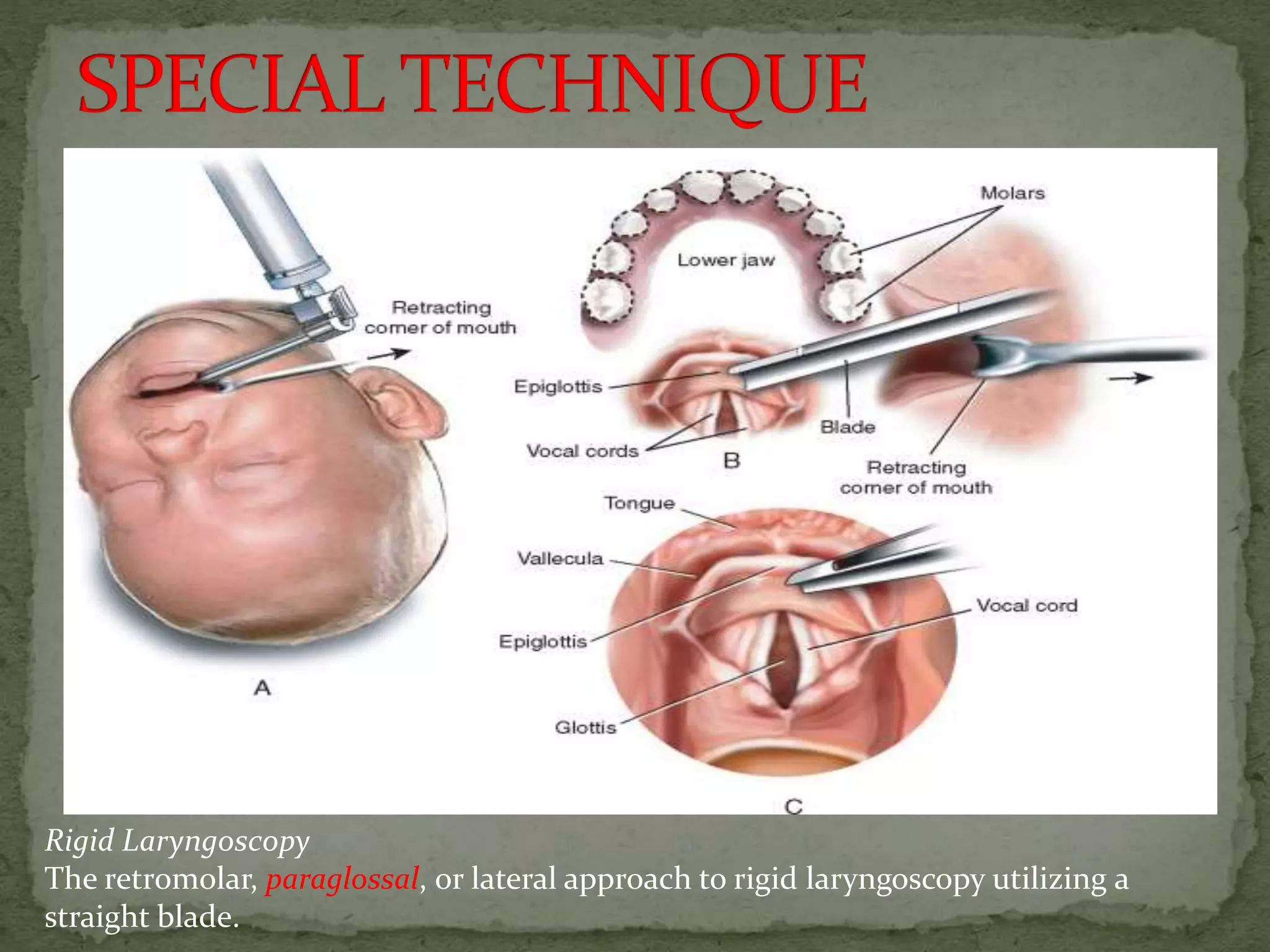Rigid Laryngoscopy
The retromolar, paraglossal, or lateral approach to rigid laryngoscopy utilizing a
straight blade.
 