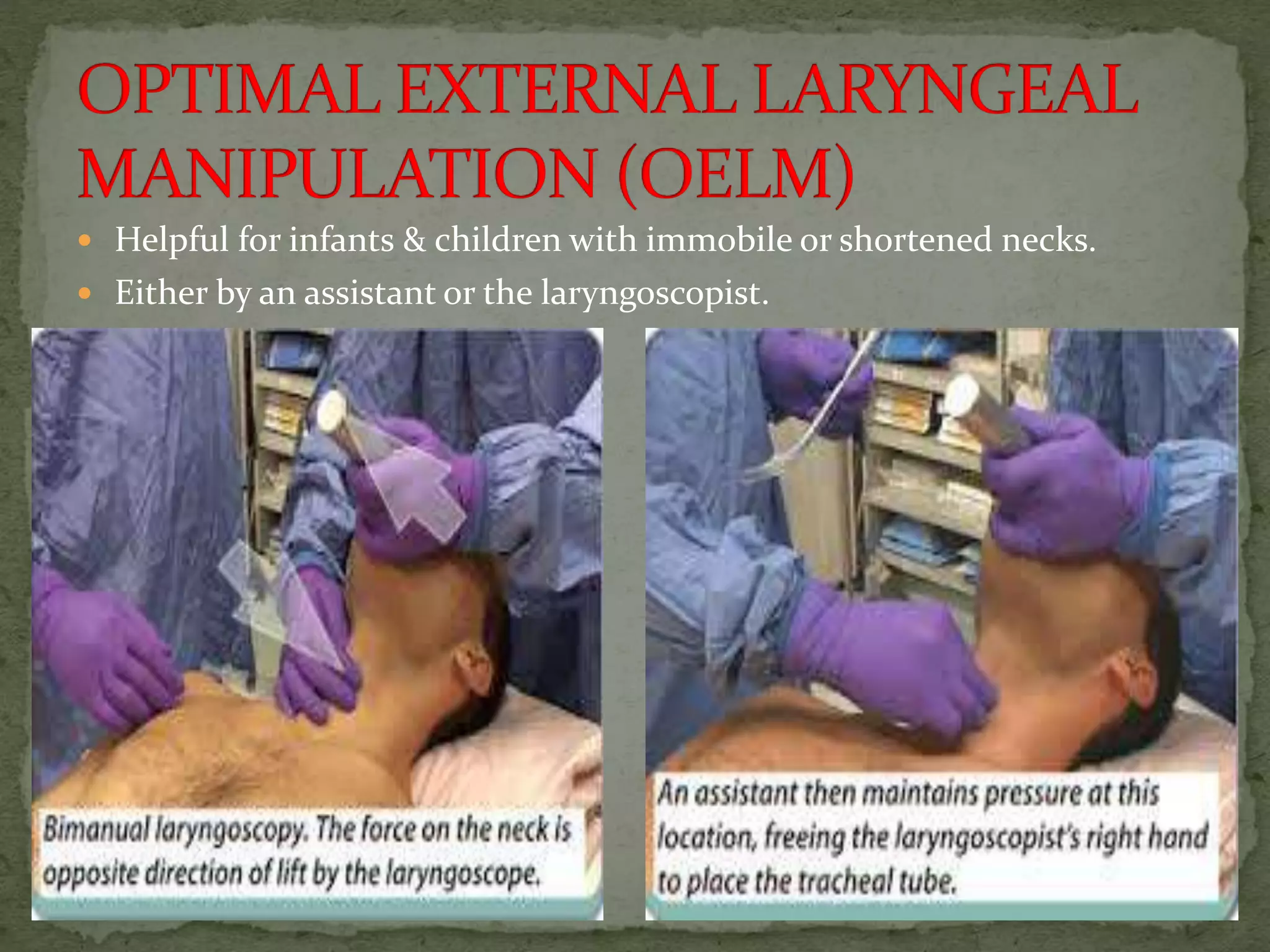  Helpful for infants & children with immobile or shortened necks.
 Either by an assistant or the laryngoscopist.
 