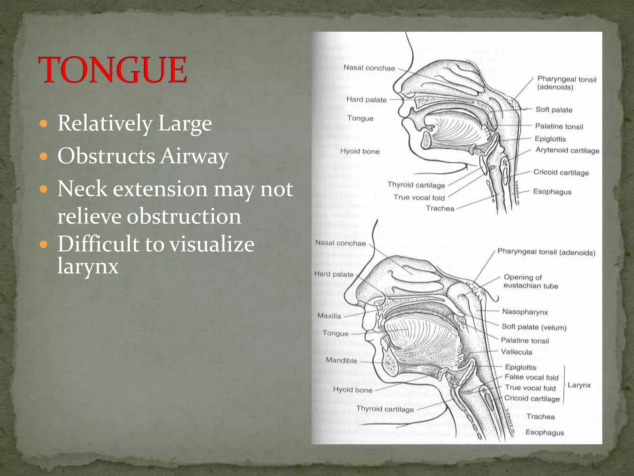  Relatively Large
 Obstructs Airway
 Neck extension may not
relieve obstruction
 Difficult to visualize
larynx
 