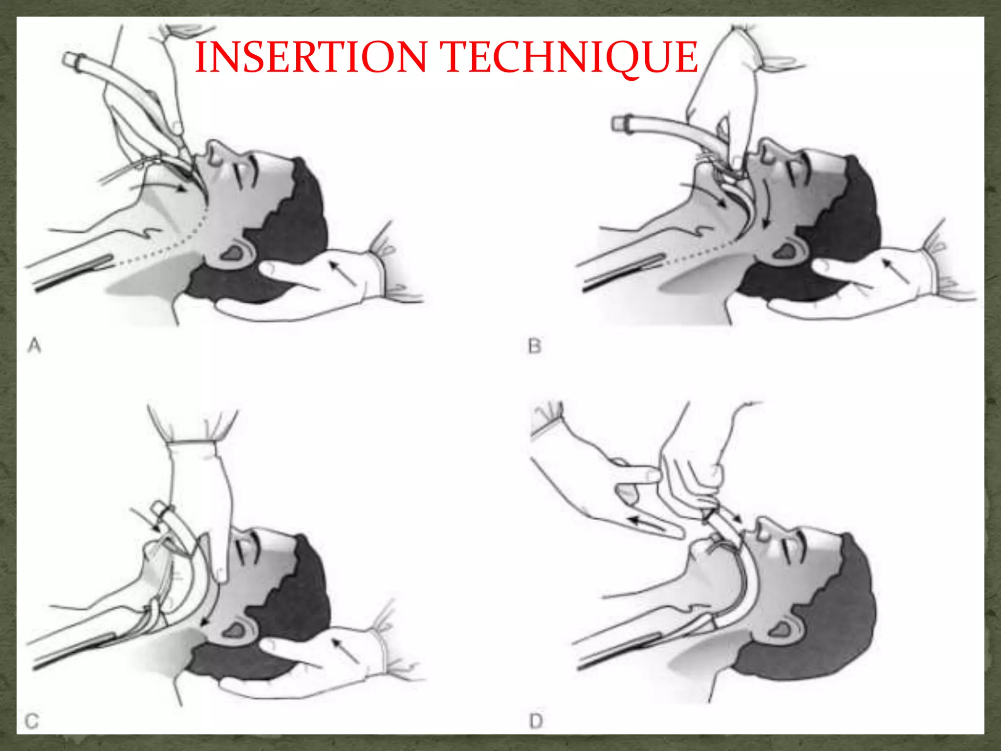 INSERTION TECHNIQUE
 
