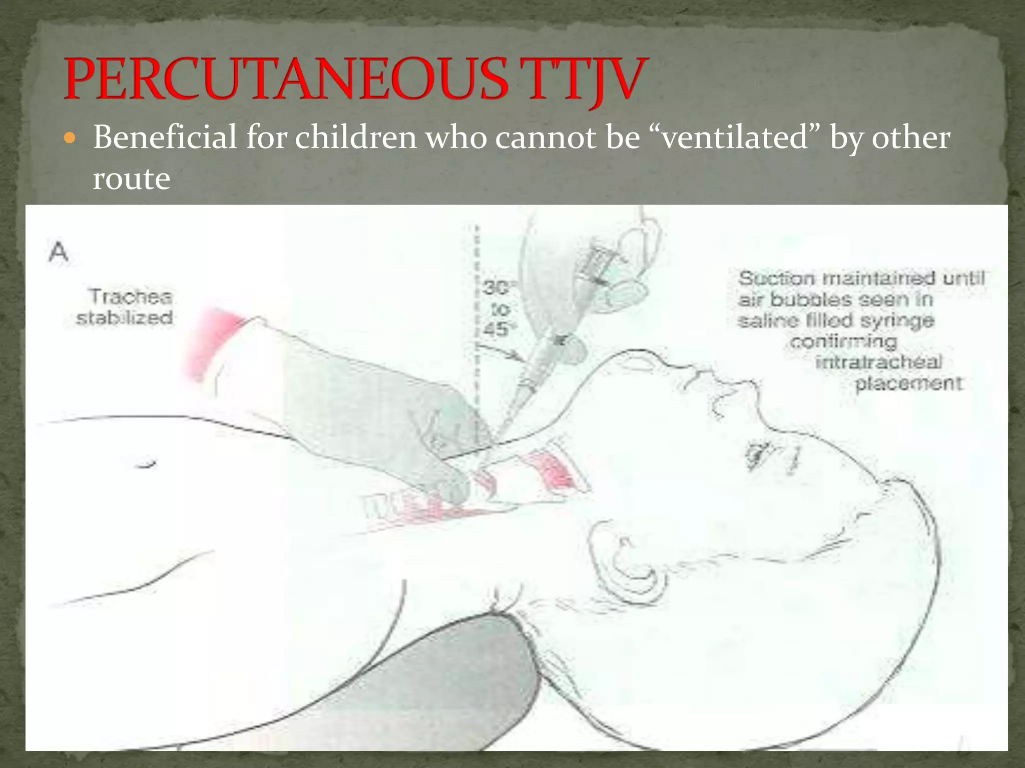  Beneficial for children who cannot be “ventilated” by other
route
 