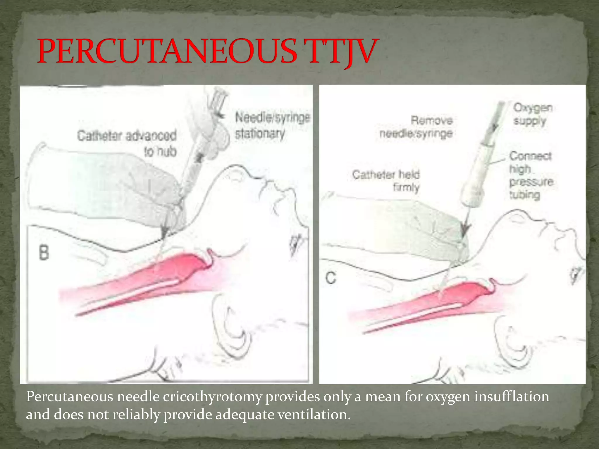 Percutaneous needle cricothyrotomy provides only a mean for oxygen insufflation
and does not reliably provide adequate ventilation.
 