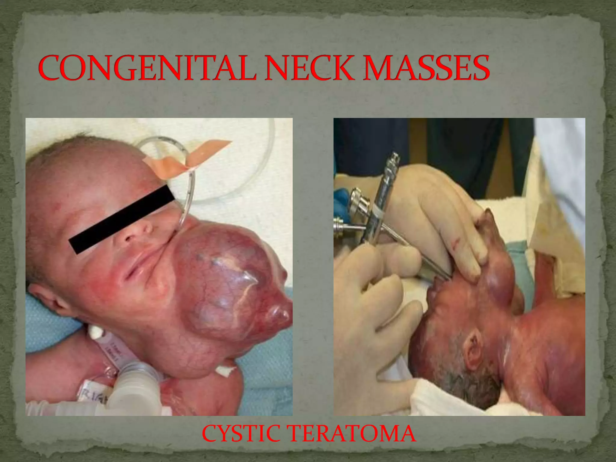 CYSTIC TERATOMA
 