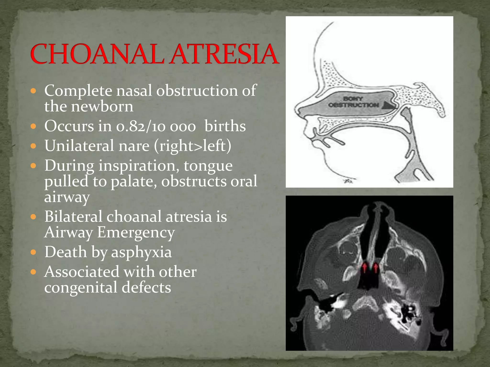  Complete nasal obstruction of
the newborn
 Occurs in 0.82/10 000 births
 Unilateral nare (right>left)
 During inspiration, tongue
pulled to palate, obstructs oral
airway
 Bilateral choanal atresia is
Airway Emergency
 Death by asphyxia
 Associated with other
congenital defects
 