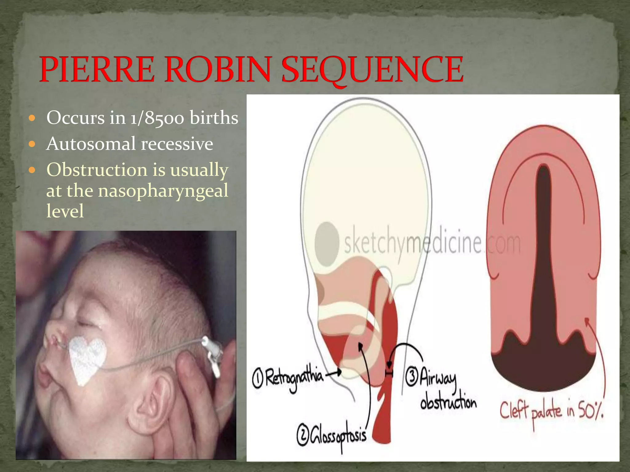  Occurs in 1/8500 births
 Autosomal recessive
 Obstruction is usually
at the nasopharyngeal
level
 