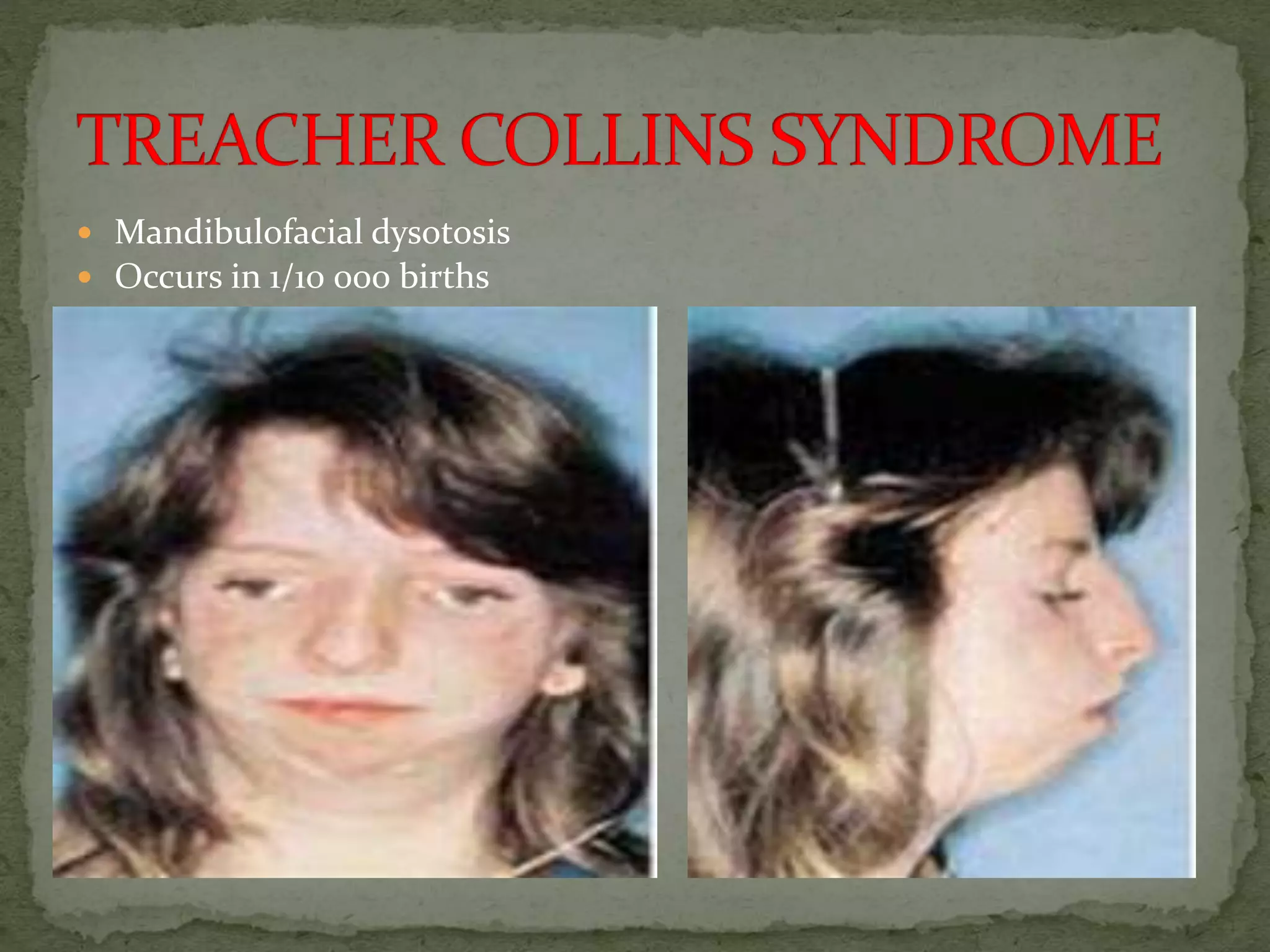  Mandibulofacial dysotosis
 Occurs in 1/10 000 births
 