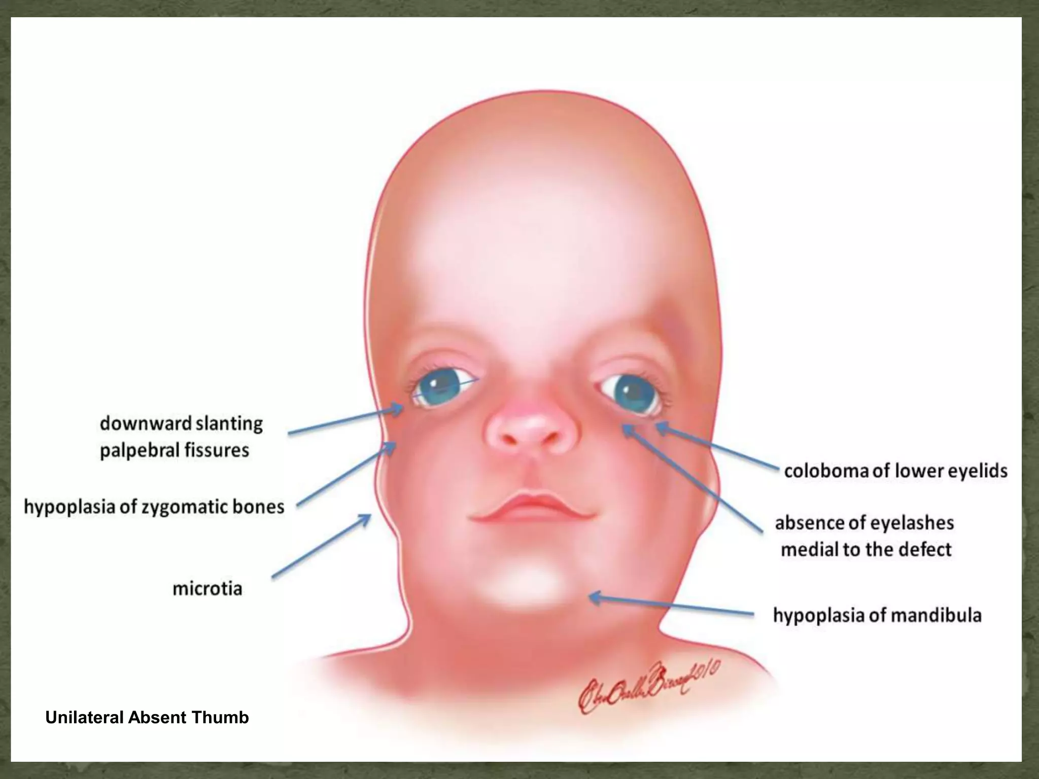 Unilateral Absent Thumb
 