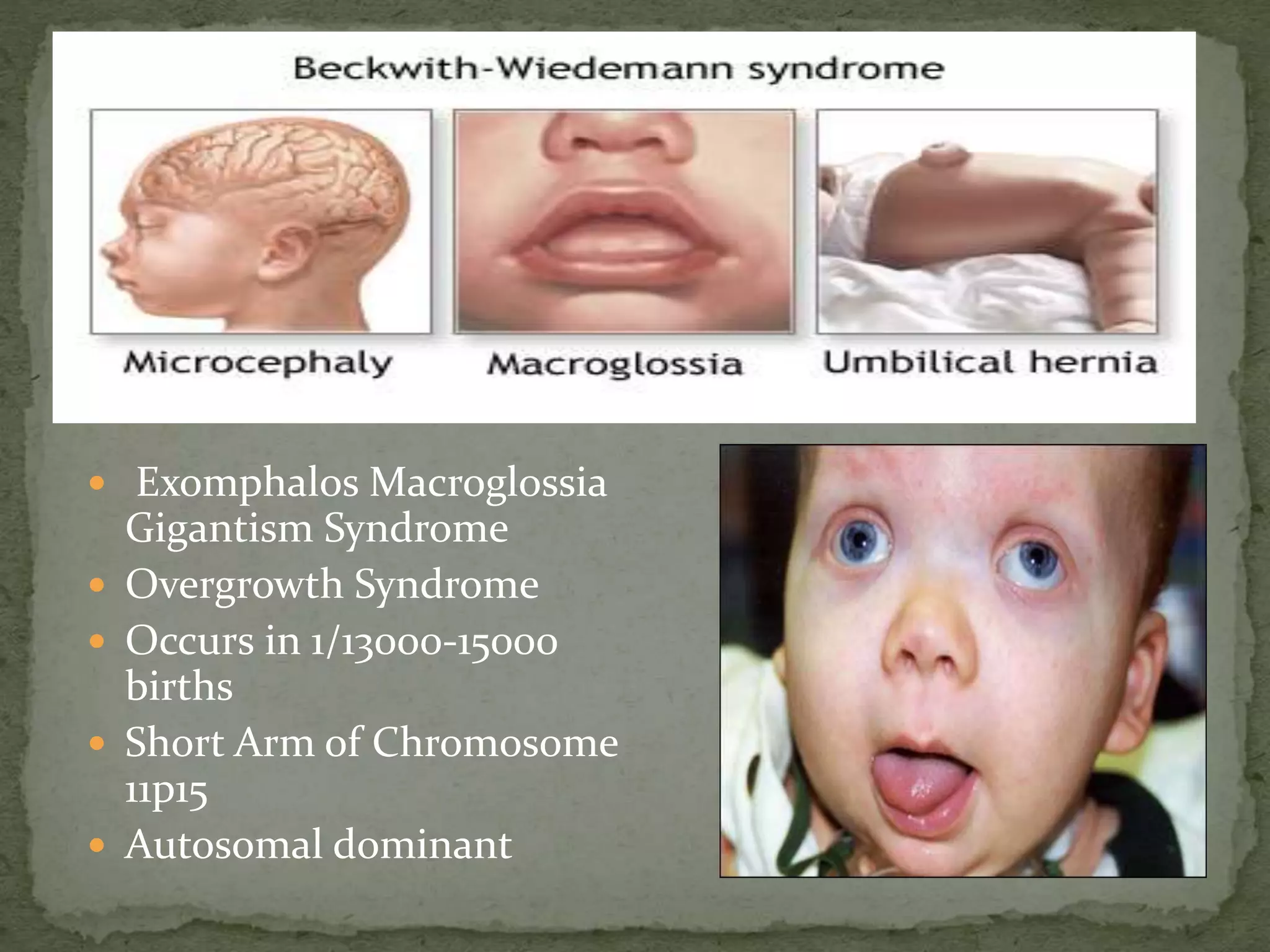  Exomphalos Macroglossia
Gigantism Syndrome
 Overgrowth Syndrome
 Occurs in 1/13000-15000
births
 Short Arm of Chromosome
11p15
 Autosomal dominant
 