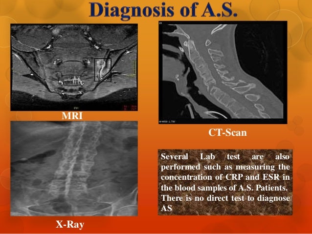 spondylitis ankylosing