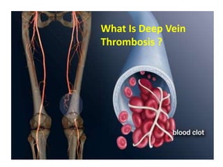 DVT PROPHYLAXIS IN ORTHOPEDIC SURGERIES | PPTX