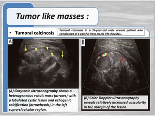 Role of ultrasound and color Doppler in evaluation of musculoskeletal ...